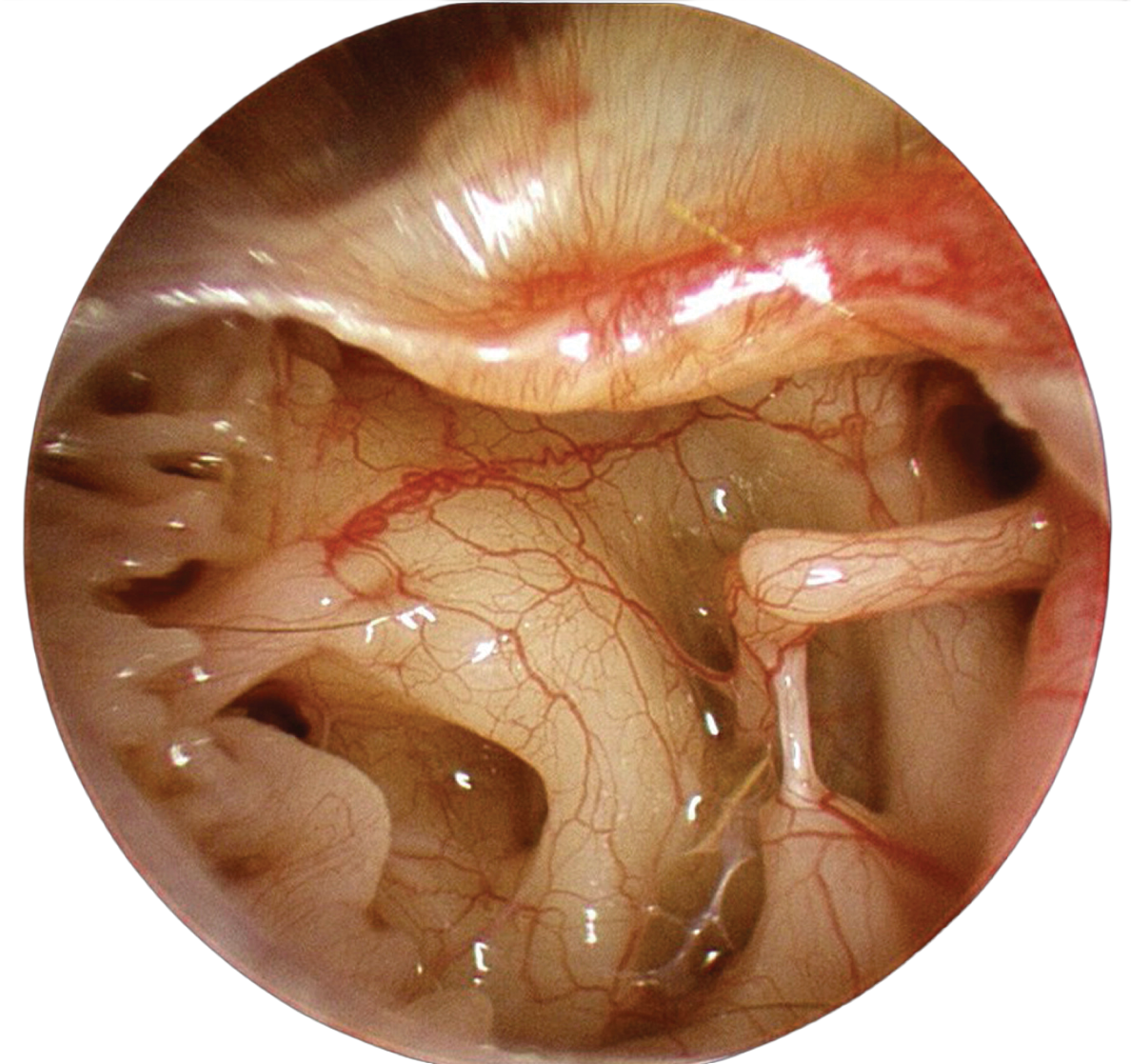 ApoClear Optic Technology - After